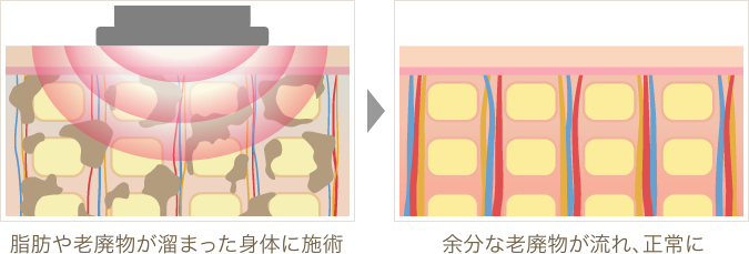 脂肪や老廃物が溜まった身体に施術